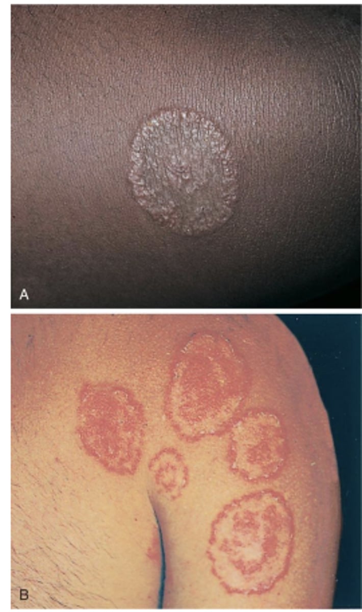 <p>Red lesions in a circular pattern blanched in the center caused by fungus, NOT a worm</p>