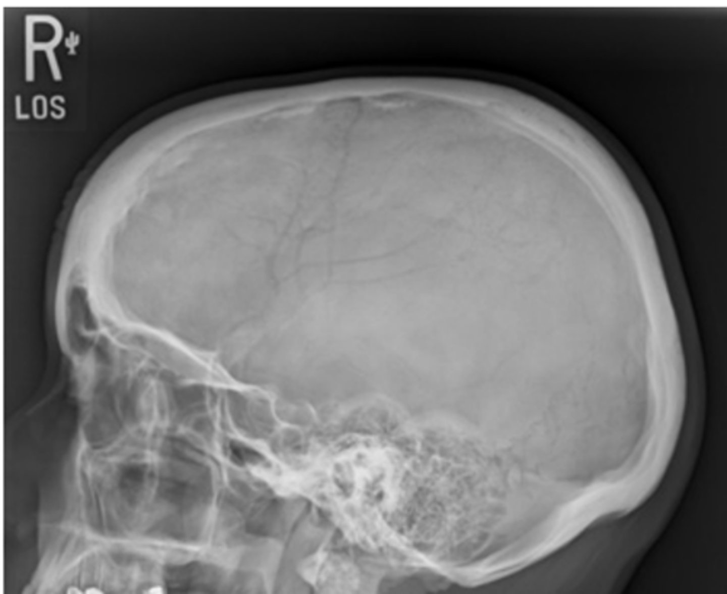 <p>-Position: </p><p>• No rotation or tilt of the cranium is evident. </p><p>• Rotation is evident by anterior and posterior separation of symmetric vertical bilateral structures such as the mandibular rami, and greater wings of the sphenoid. </p><p>• Tilt is evident by superior and inferior separation of symmetric horizontal structures such as the orbital roofs (plates) and greater wings of sphenoid</p>