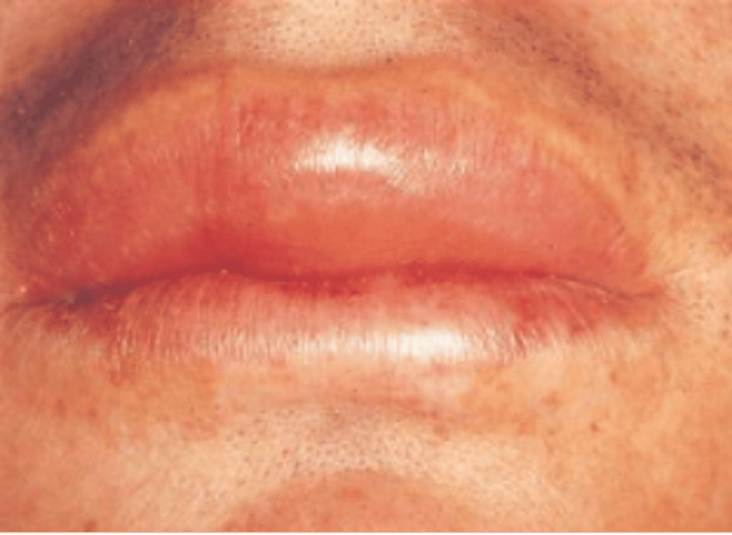 <p>The diffuse swelling caused by the increased permeability of deeper blood vessels depicted in the image below is called</p>