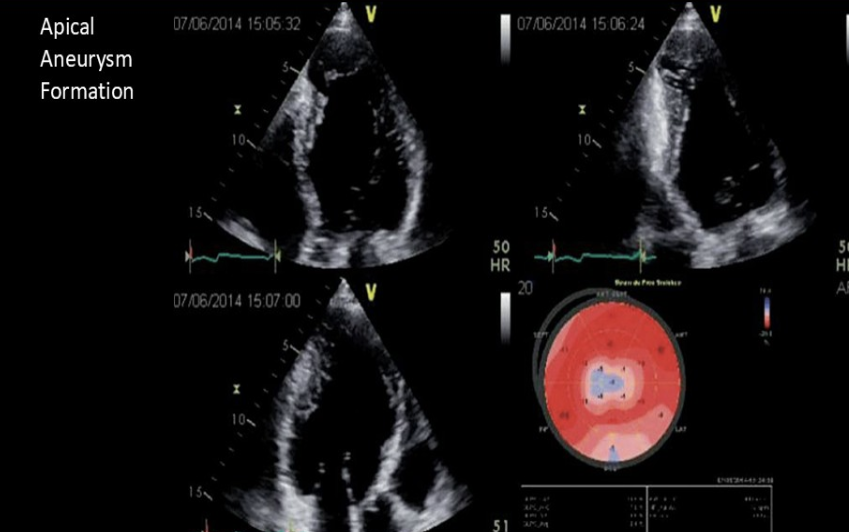 <p>What are you looking for after a recent diagnosis of Chagas disease? </p>