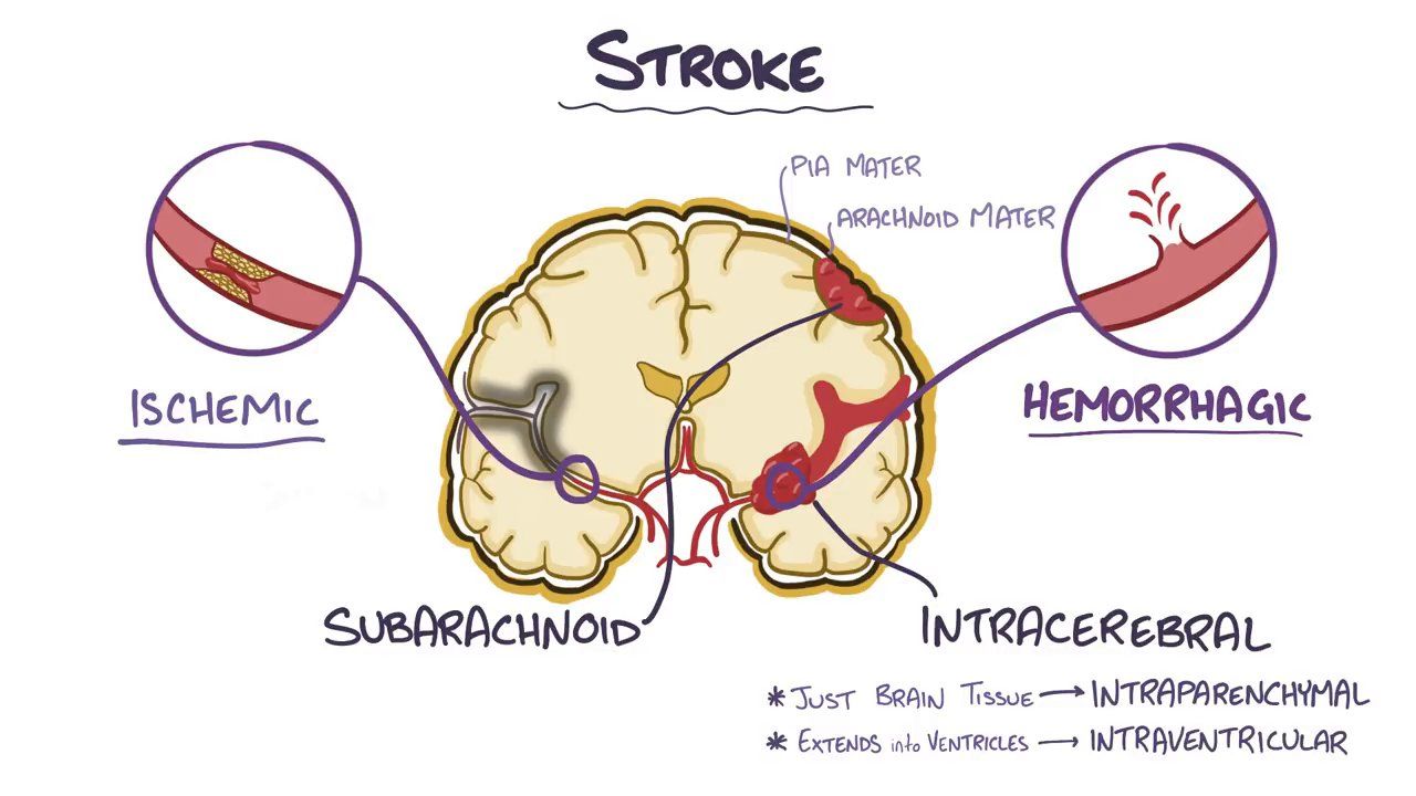 <p>A type of hemorrhage that occurs in the space between the arachnoid membrane and the pia mater, known as the subarachnoid space. It is usually caused by the rupture of an artery, resulting in bleeding around the brain. Subarachnoid hemorrhage can lead to severe headaches, neck stiffness, and neurological deficits.</p>