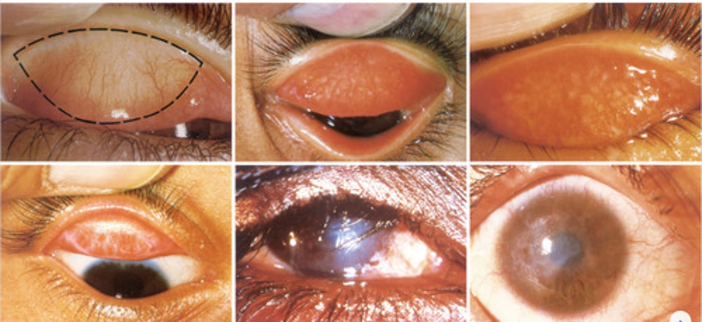 <p>certain strains of chlamydia trachomatis</p>