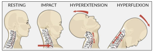 <p><u>Hyperextensie</u> van hals (overbuigen) → <u>hyperflexie</u> hals (te ver overstrekken)</p><ul><li><p><em>vb. in auto zitten die stilstaat/langzaam rijdt → plots van achteren aangereden</em></p></li><li><p>geen hersenschudding</p></li><li><p>kan gepaard gaan met letsels thv hals/nek</p></li></ul><p></p>