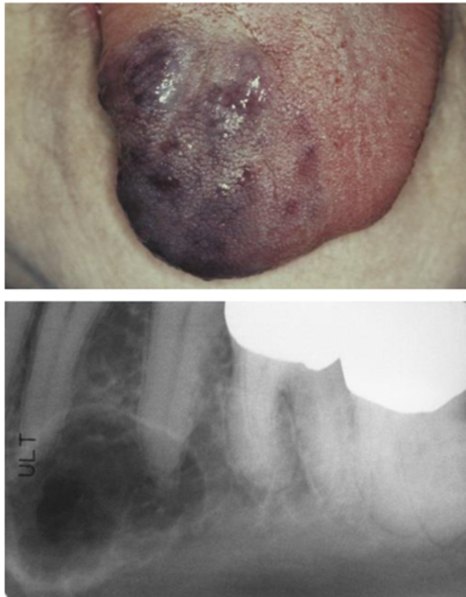 <p>◦ Most common sites in the head</p><p>and neck:</p><p>◦ Lips, tongue, buccal mucosa, or</p><p>palate</p><p>◦ Deep red or blue compressible</p><p>lesion</p><p>◦ Lesions can in the soft tissue or</p><p>central (intraosseous) in location</p>