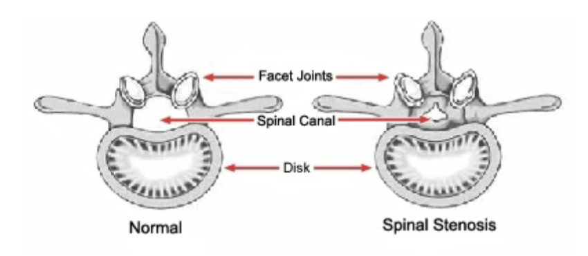 <p><strong>What is Spondylosis (stenosis)?</strong></p>