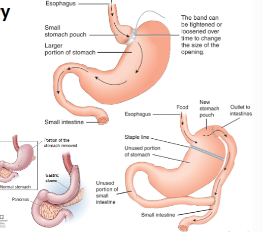 <ul><li><p>bariatric surgery: gastric banding, gastric bypass, sleeve gastrectomy</p></li><li><p>typically limited to higher obesity classes and obesity and established comorbidities</p></li><li><p>requires lifelong changes in diet adn lifestyle to accommodate permanent to GI physiology and absorption</p></li><li><p>good outcomes</p></li></ul><p></p>