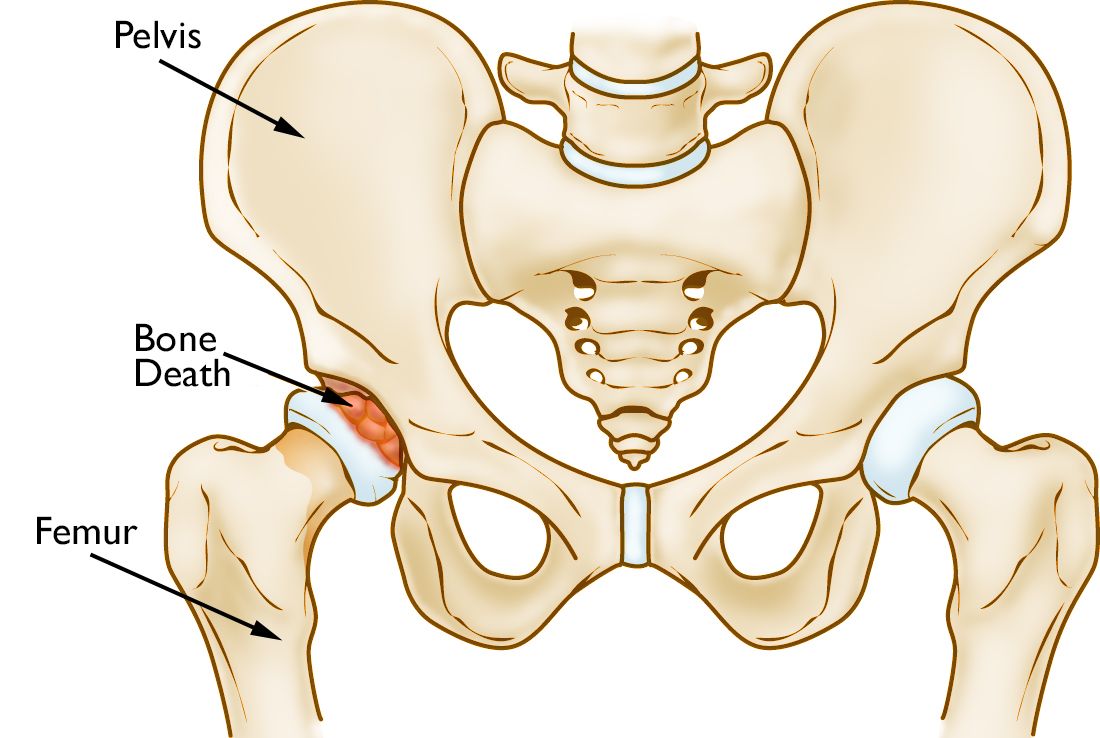 <p>Dead bone tissue from lack of blood supply</p><ul><li><p>Etiol: Ischemia (low BF) or Infarction (no BF) to bone, Fat Embolism</p></li><li><p>S/S: Asymptomatic (early), Pain (late)</p></li><li><p>Tx: Joint Replacement (must replace)</p></li></ul><p></p>