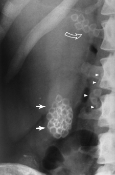 <p>Cholelithasis </p>