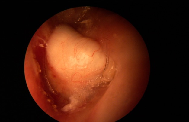 <p>abnormal collection of skin cells deep inside the ear; rare </p>