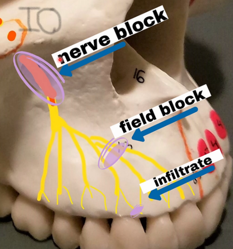 <p>Local Infiltration: Small terminal nerve endings in the area are flooded with anesthetic → PDl Injections or pulpal → Tx is done on same area in which L.A is deposited</p><p>Field Block: L.A is deposited near the larger terminal nerve branch so the area will be circumscribed and preventing the passage of impulses from the tooth to the CNS</p><p>Nerve blocks: L.A deposited close to the main nerve trunk at a distance to prevent operative intervention</p>