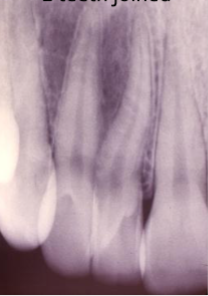 <p>what dental abnormality is shown here?</p>