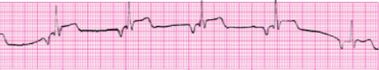 <p>name a key identifier of a Junctional Arrhythmia on an ECG</p>