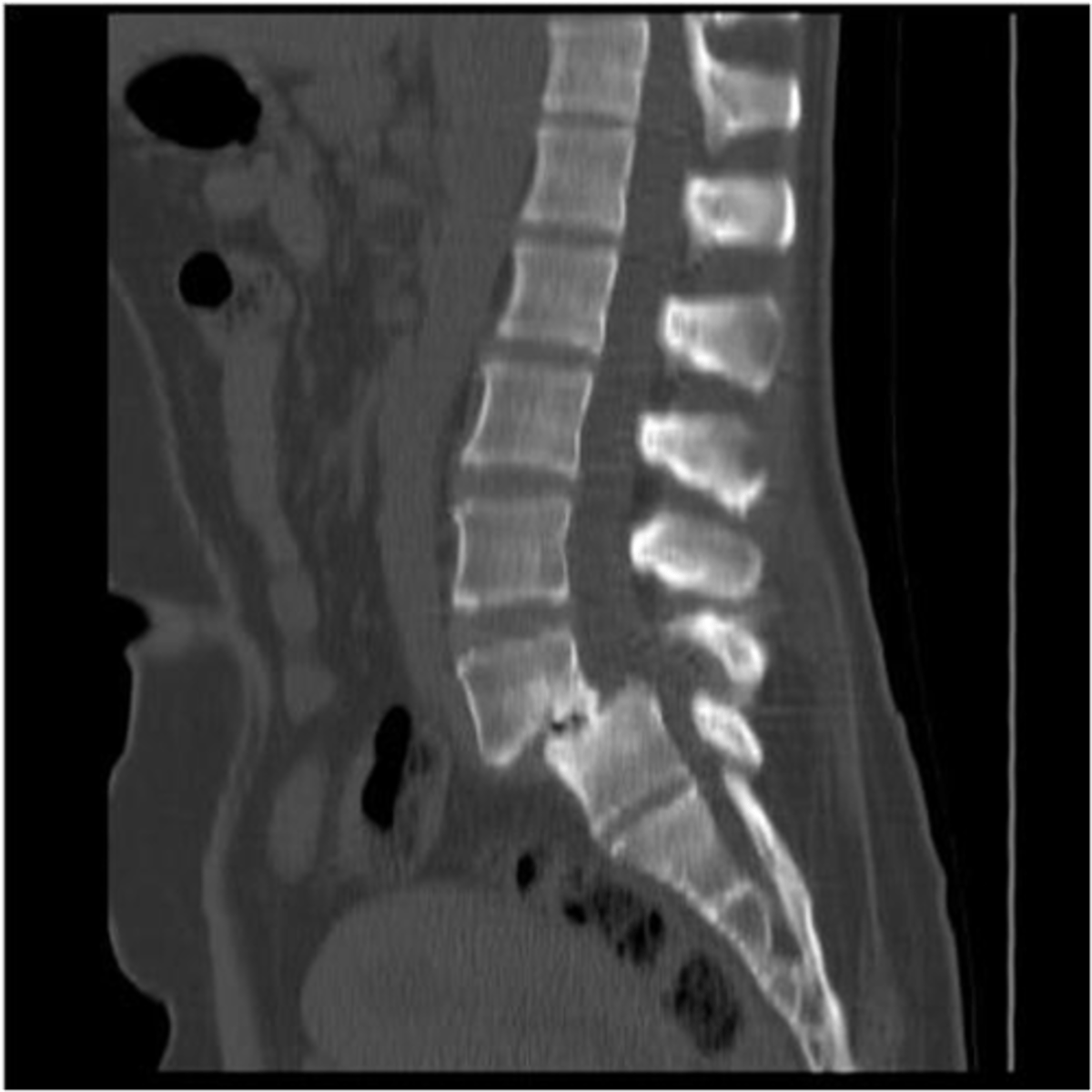 <p>degenerative or traumatic etiology</p>
