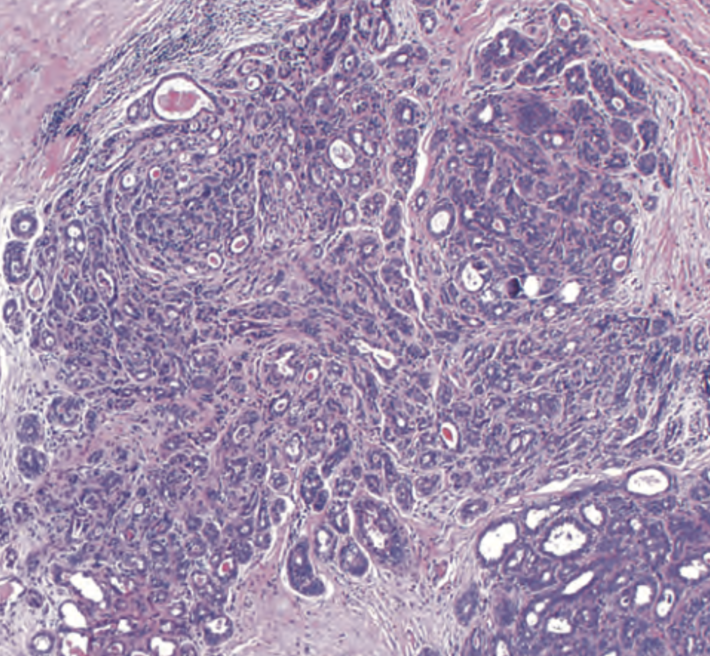 <p>Aumento de acinos comprimidos y distorsionados en la parte centeal con fibrosis estromal. La fibrosis Crea hebras de doble celulas que se confunde superficial con carcinoma invasivo. </p>