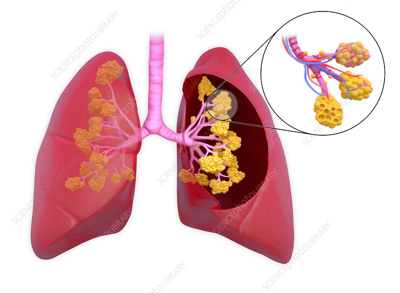 <p>Which structure collapses first without surfactant: bronchi or alveoli?</p>