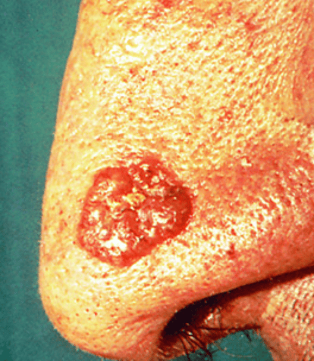 <p>-Most common form of skin cancer</p><p>-Predominantly affects light skin individuals (40-80)</p><p>-Locally invasive (rarely metastasizes)</p><p>-More common in males</p>