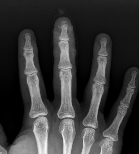 <p>Describe the abnormality demonstrated. </p>