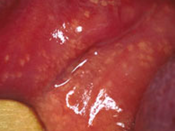 <ul><li><p>Sebaceous glands</p></li><li><p>Inner buccal and corners of mouth</p></li></ul><p></p>