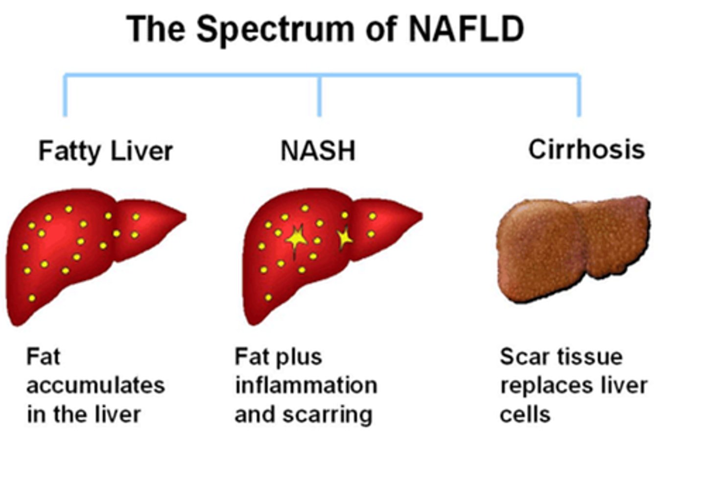 <p>An acronym for Non-alcoholic fatty liver disease.</p>