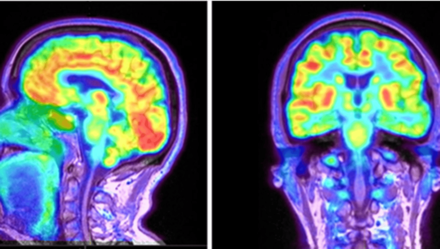 <p>alzheimer's disease, epilepsy, parkinson's disease, mets</p>