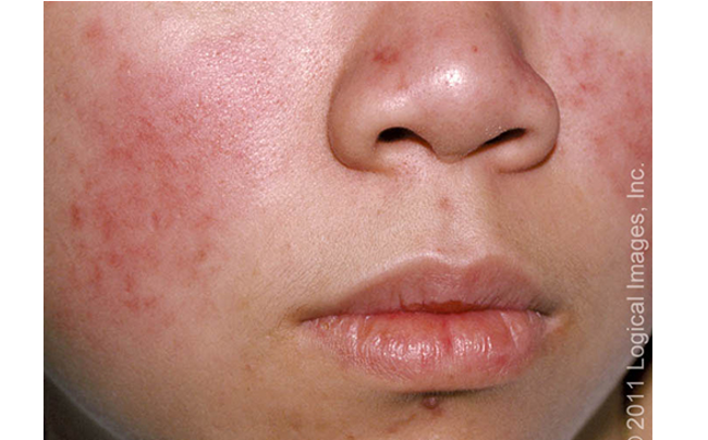 <ul><li><p>malar or butterfly rash: erythema along cheeks and bridge of nose; spares nasolabial folds; may last hrs-wks; exacerbated by sun exposure</p></li><li><p>morbilliform rash: erythematous maculopapular eruption on sun exposed areas</p></li><li><p><u>histology</u>: <strong>apoptotic keratinocytes, </strong>vascuolization of basal cell layer; <strong>lymphohistiocytic infiltrate</strong> in superficial dermis and dermic mucin deposition</p></li></ul><p></p>