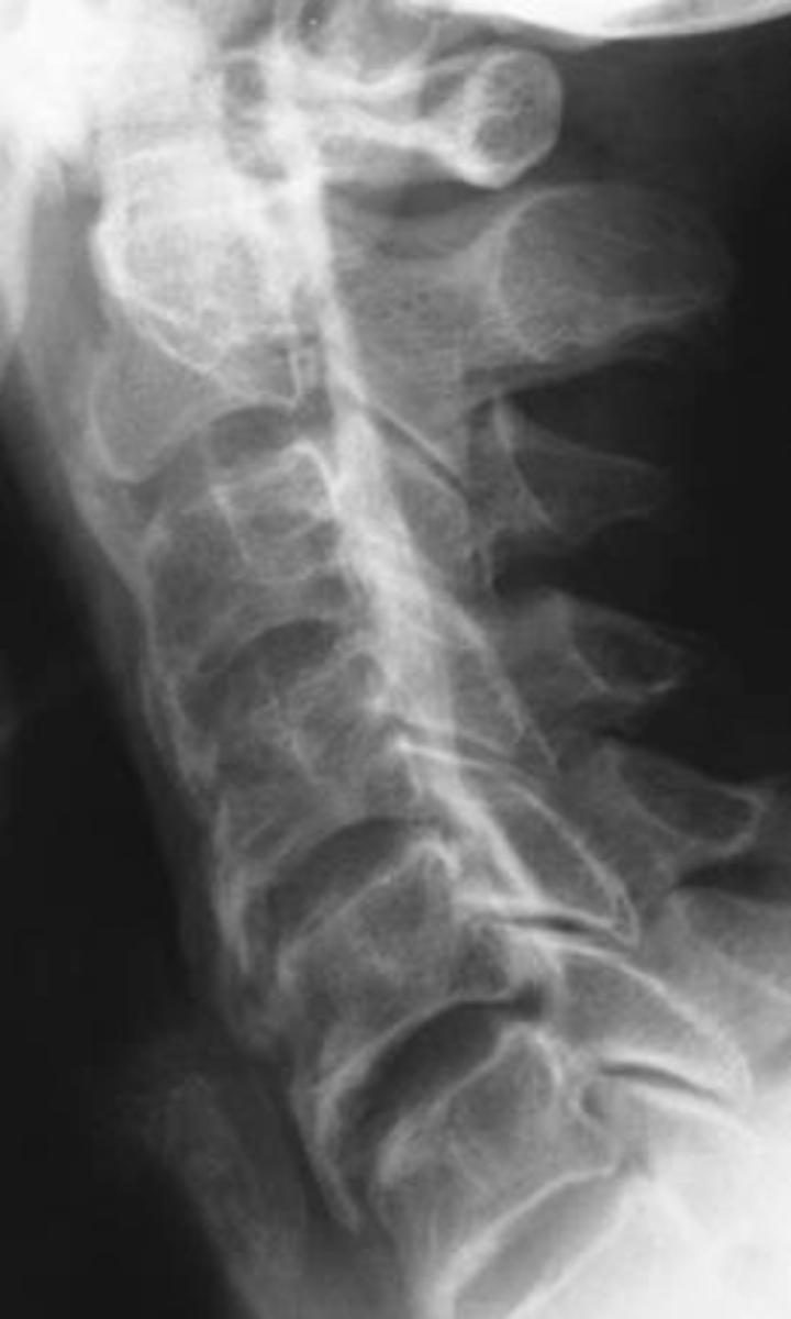 <p>ID complication of diffuse idiopathic skeletal hyperostosis (DISH)</p>