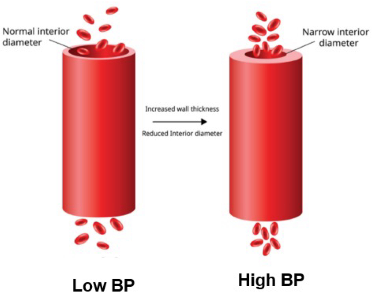 <p><strong>blood pressure (BP)</strong>: force exerted on a given area of vessel wall by blood (mmHg)</p><ul><li><p>force mainly generated by ventricular contraction</p></li><li><p>area = diameters of vessel</p><ul><li><p>↑ area (vasodilation) → ↓ resistance → ↓ bp</p></li><li><p>↓ area (vasoconstriction) → ↑ resistance → ↑ bp</p></li></ul></li></ul><p><em>pressure (P) = force / area</em></p><p><em>pulse pressure - systolic pressure - diastolic pressure</em></p><p><em>mean arterial pressure (MAP) = diastolic pressure + 1/3 pulse pressure</em></p>