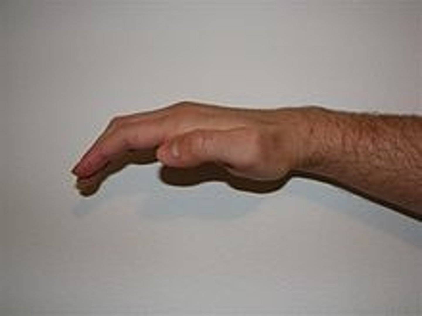 <p>weakness and atrophy of the muscles of the thenar eminence result in overemphasis of the extensor muscles, which pull the thumb pararell with the fingers. Opposistion and flexion of the MCP and IP are weakened. median nerve neuropathy</p>