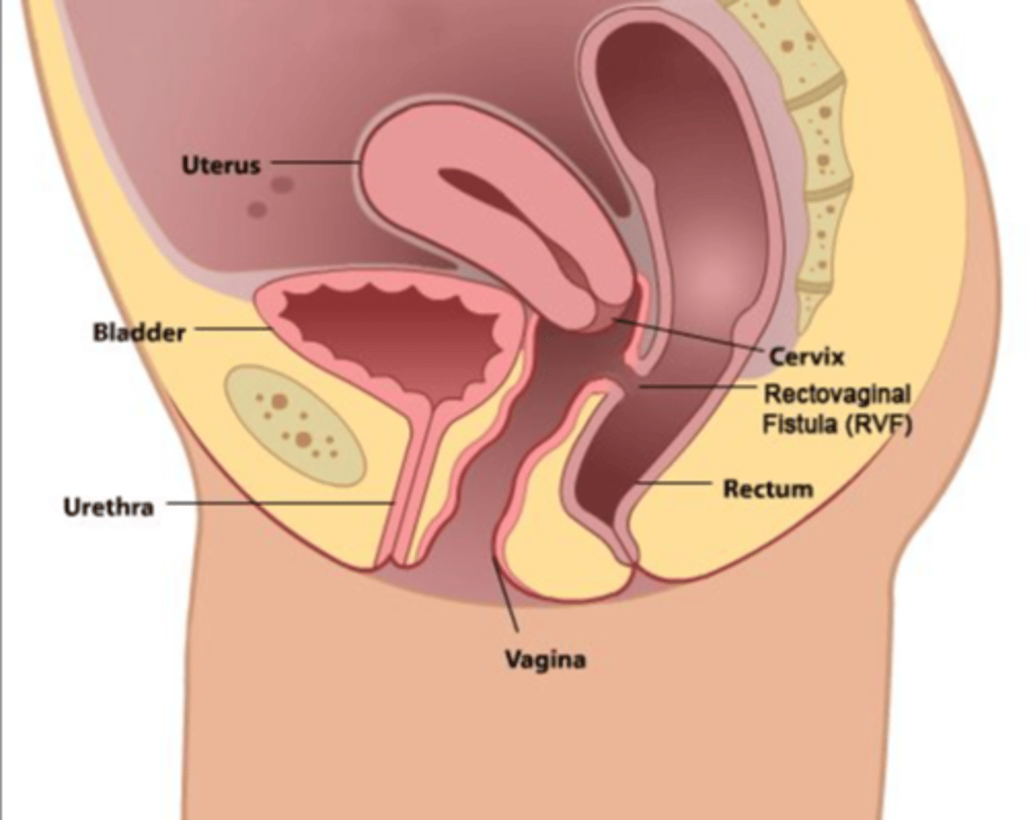 <p>a fistula between the rectum and vagina</p>
