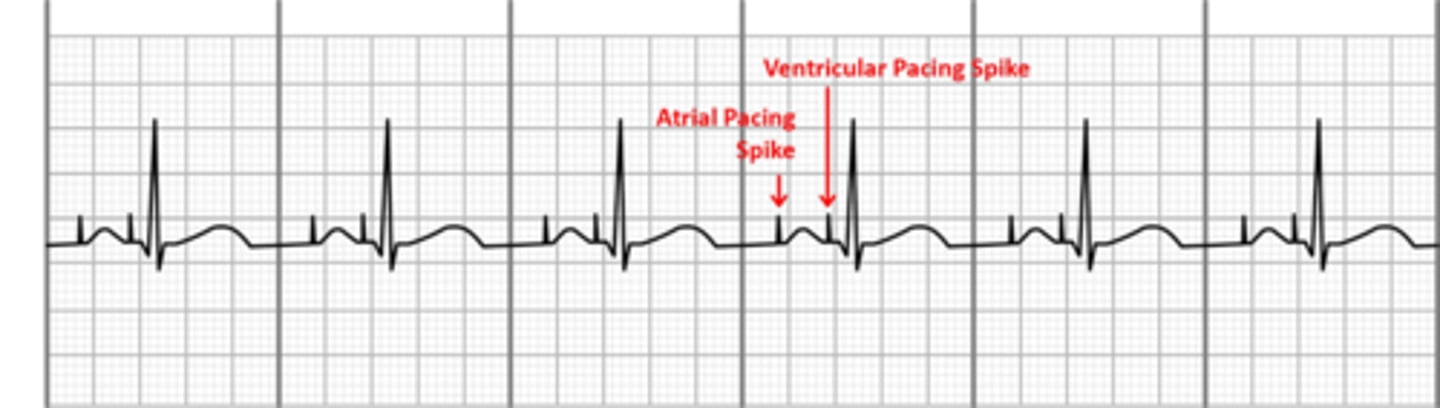 <p>Whay kind of pacemaker is this?</p>