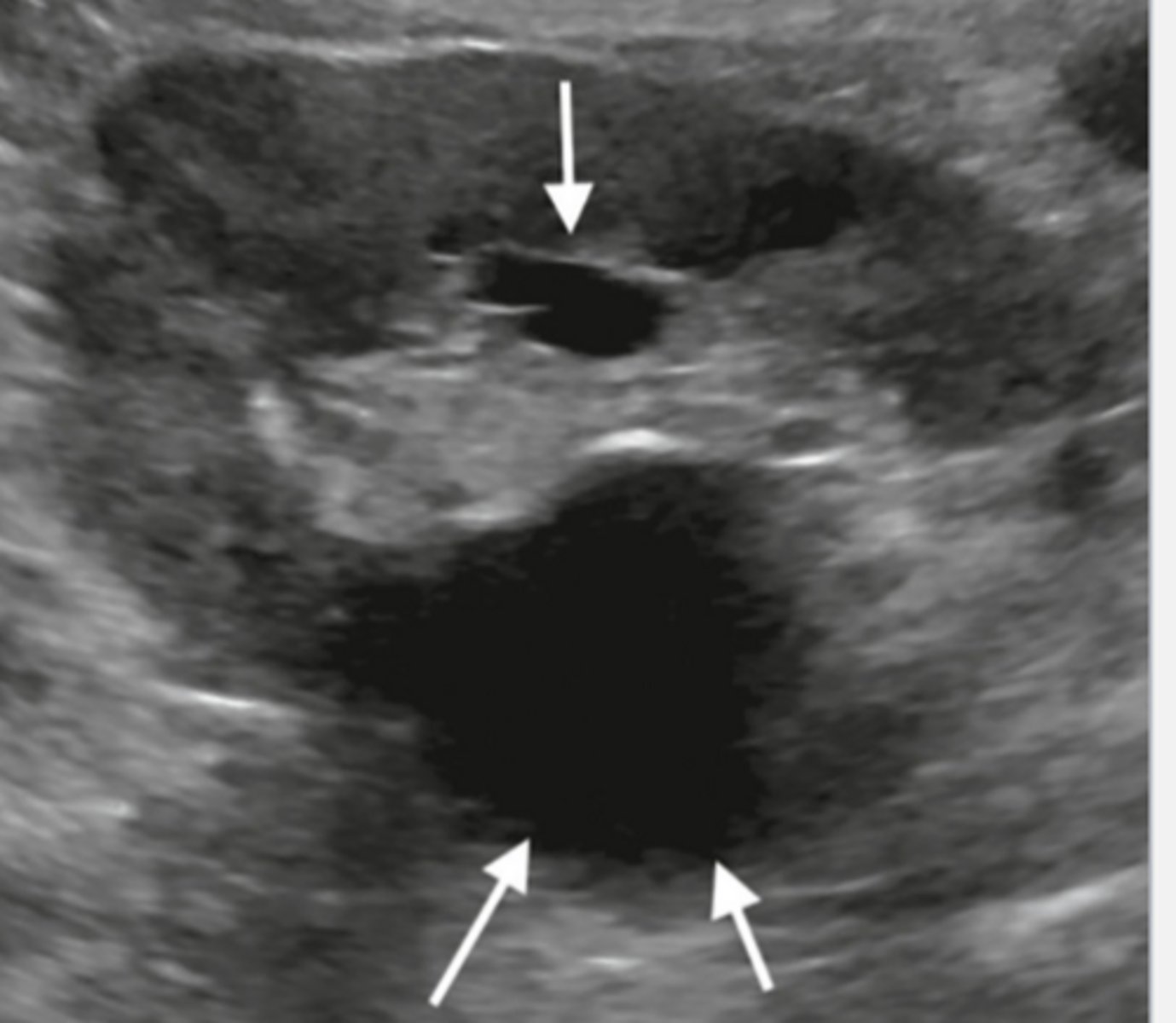 <p>The parapelvic cyst is going to be located in the ___ ___, originate from the ___ ___, and protrude into the ___ ___.</p>