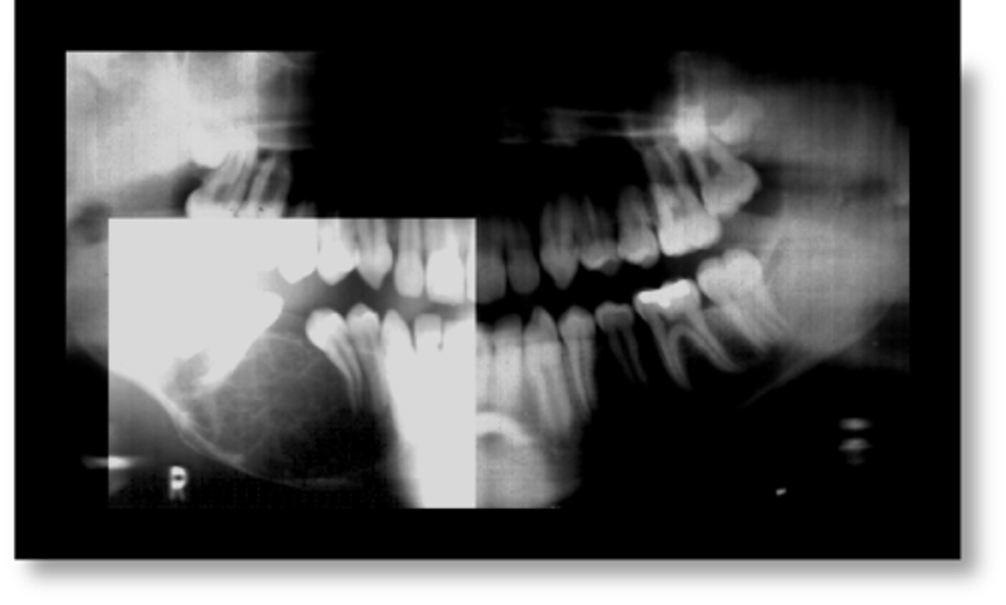 <p>this lesion has been described as having "tennis racket" appearance due to its thin straight septations:</p>