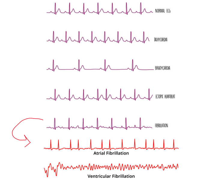 <p><strong>Tachycardia</strong> - fast heartbeat (over 100 bpm)</p><p><strong>Bradycardia</strong> - slow heartbeat (under 60 bpm)</p><p><strong>ectopic heartbeat </strong>- an extra heartbeat that occurs out of the normal rhythm.</p><p><strong>fibrillation </strong>- irregular heartbeat</p><p>→2 types: atrial and ventricular fibrillation </p>