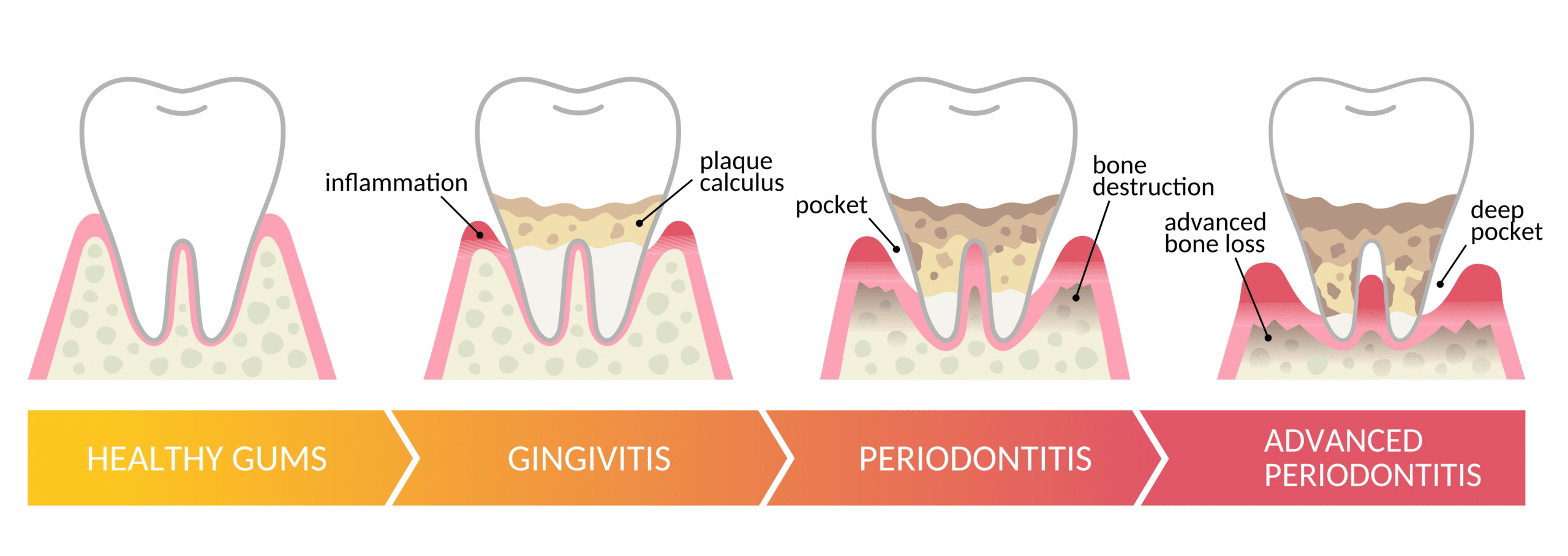 <ul><li><p>Advanced inflammation causing the gums to bleed and pull away from the teeth.</p></li></ul><ul><li><p>Caused mostly by <strong>P. GINGIVALIS</strong></p></li></ul><p></p>