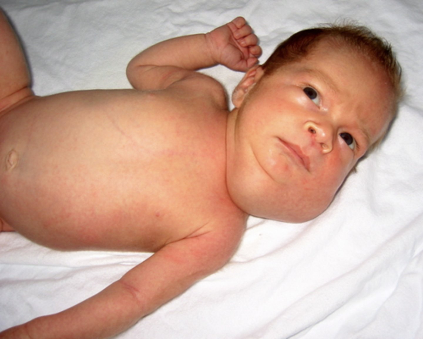 <p>a congenital defect that produces a benign mass in the head/neck that presses on trachea of the newborn </p>