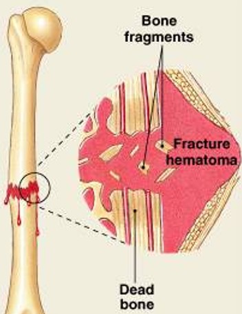 <p>Which step of fracture repair have:</p><ul><li><p><span style="color: yellow;"><strong>Bleeding:</strong></span></p><ul><li><p><span style="color: yellow;"><strong>Produces a clot</strong></span> (fracture hematoma)</p></li><li><p>Establishes a fibrous network</p></li></ul></li><li><p>Bone cells in the area die</p></li></ul><p></p>