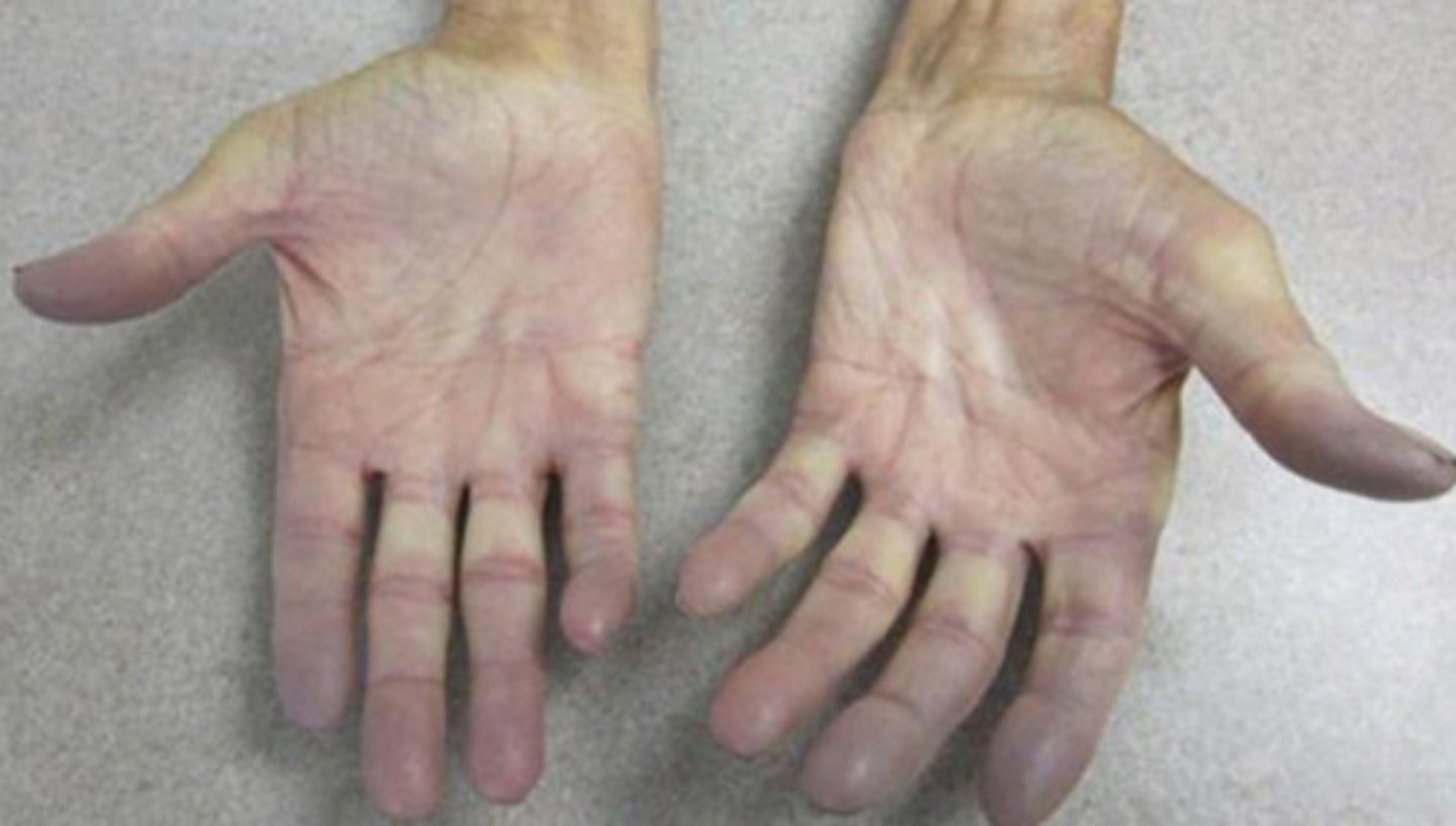 <p>what are the sxs/s of Raynaud's phenomenon?</p><p>treatment?</p>