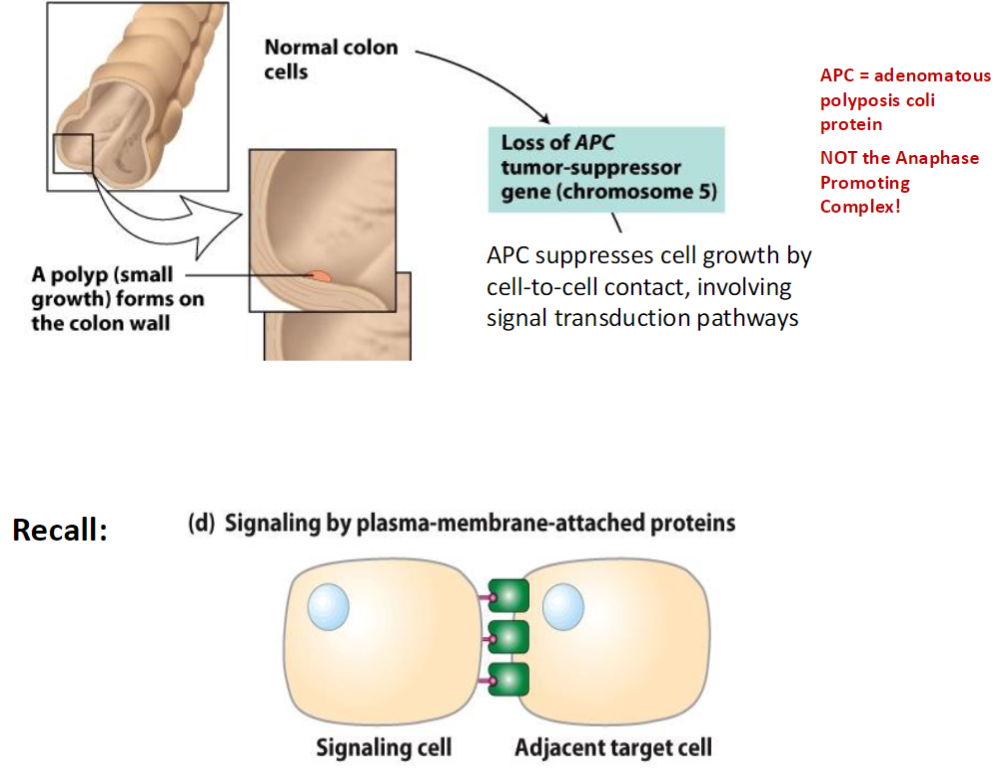 <p><strong>Normal Colon Cells</strong><br> Cells grow and function normally, maintaining <strong>tissue architecture</strong></p><p><strong>Polyp Formation</strong><br> A <strong>polyp</strong> (small growth) forms on the <strong>colon wall</strong></p><p><strong>APC Gene Loss</strong><br> Loss of <strong>APC</strong> (<strong>adenomatous polyposis coli protein</strong>, chromosome 5)<br>  (Not the <strong>Anaphase Promoting Complex</strong>)<br> <strong>APC function:</strong> suppresses <strong>cell growth</strong> via <strong>cell-to-cell contact</strong> and <strong>signal transduction pathways</strong></p><p><strong>Signaling Reminder</strong><br> <strong>Signaling by plasma-membrane-attached proteins</strong> involves a <strong>signaling cell</strong> and an <strong>adjacent target cell</strong></p>