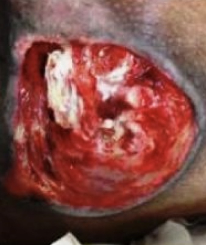 <p>Full-thickness loss with exposed bone, muscle, or tendon</p><p>Undermining and tunneling may occur</p><p>May be slough or eschar</p>