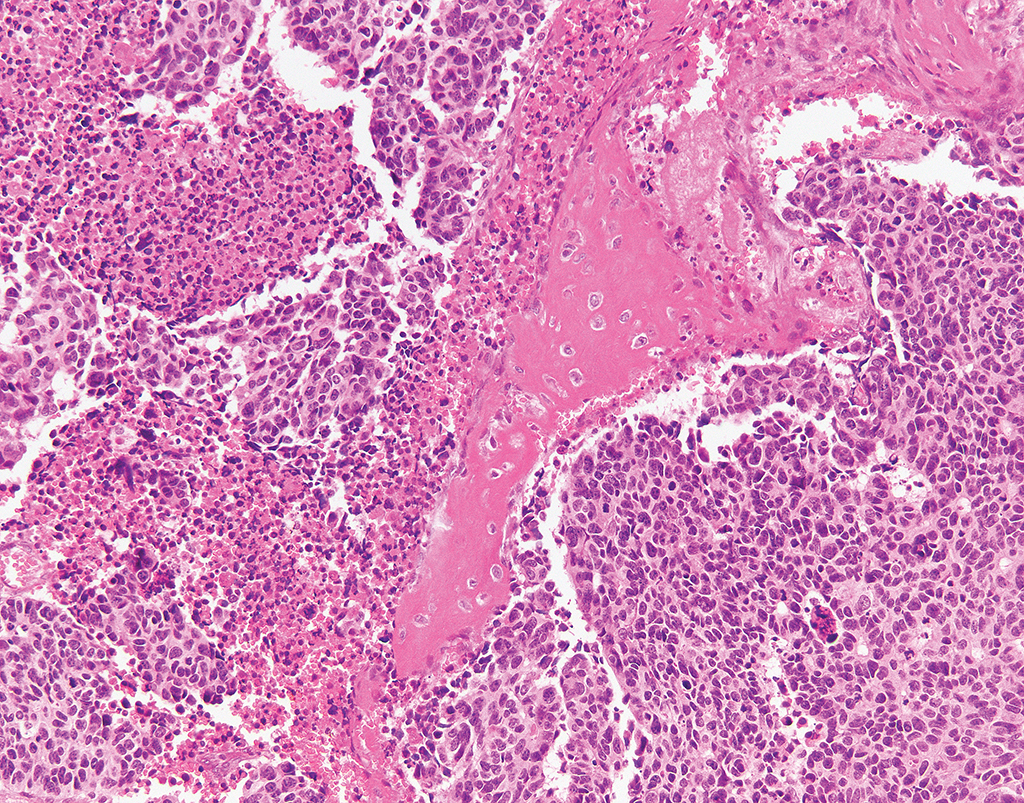 <p>Patient avec masse cavité nasale </p><p>1) Diagnostic</p><p>2) Etiologie</p><p>3) Histo</p><p>4) IHC </p><p>5) moléculaire </p>