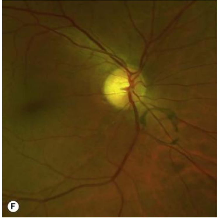 <p>Collapse of the vitreous body </p><ul><li><p><strong>Cortex sinks to center </strong></p></li></ul><p>Due to<strong> normal liquefaction and age changes </strong></p><p><strong>Posterior vitreous detaches </strong>from the retinal internal limiting membrane <strong>at the peripapillary ring </strong></p><p>May occur prematurely in cases of trauma, high myopia, etc.</p><p><strong>Weiss Ring (Senile Annular Ring) </strong></p><ul><li><p>Glial tissue from peripapillary attachment may remain in vitreous after PVD </p></li><li><p>Appears as a circular ring on examination, just over the nerve </p></li><li><p>Patient may see large floaters for days/weeks after detachment</p></li></ul><p><strong>During acute PVD stage</strong>, patients may notice an <strong>increase in floaters </strong></p><p>If there is a<strong> particularly strong attachment</strong> between the posterior hyaloid and the ILM of the retina, a PVD may result in: </p><ul><li><p>A<strong> retinal break (tear, hole) </strong></p></li><li><p><strong>Vitreo-retinal traction</strong>, especially in the <strong>foveal region </strong></p></li></ul><p><strong>Monitor patients 4-6 weeks after PVD onset </strong>for retinal complications</p>