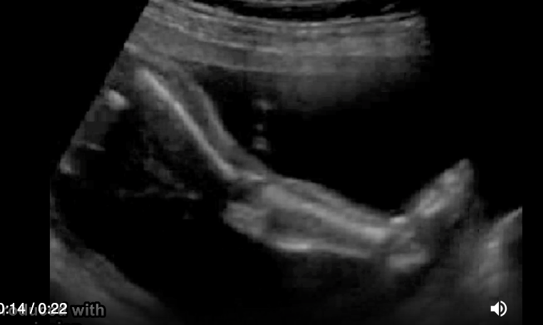 <p>mother says fetal <strong>motion</strong> has been very <strong>limited</strong></p><p>a) arthrogryposis [contraction/fixation]</p><p>b) osteogenesis imperfecta [brittle bone disease]</p><p>c) achrondroplasia [dwafism]</p><p>d) rhizomelia [femur/humerus shortening]</p>