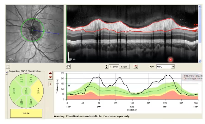 <p>onh swelling</p><p>margins not distinct </p><p>on oct shows very thick as above normal limits </p>