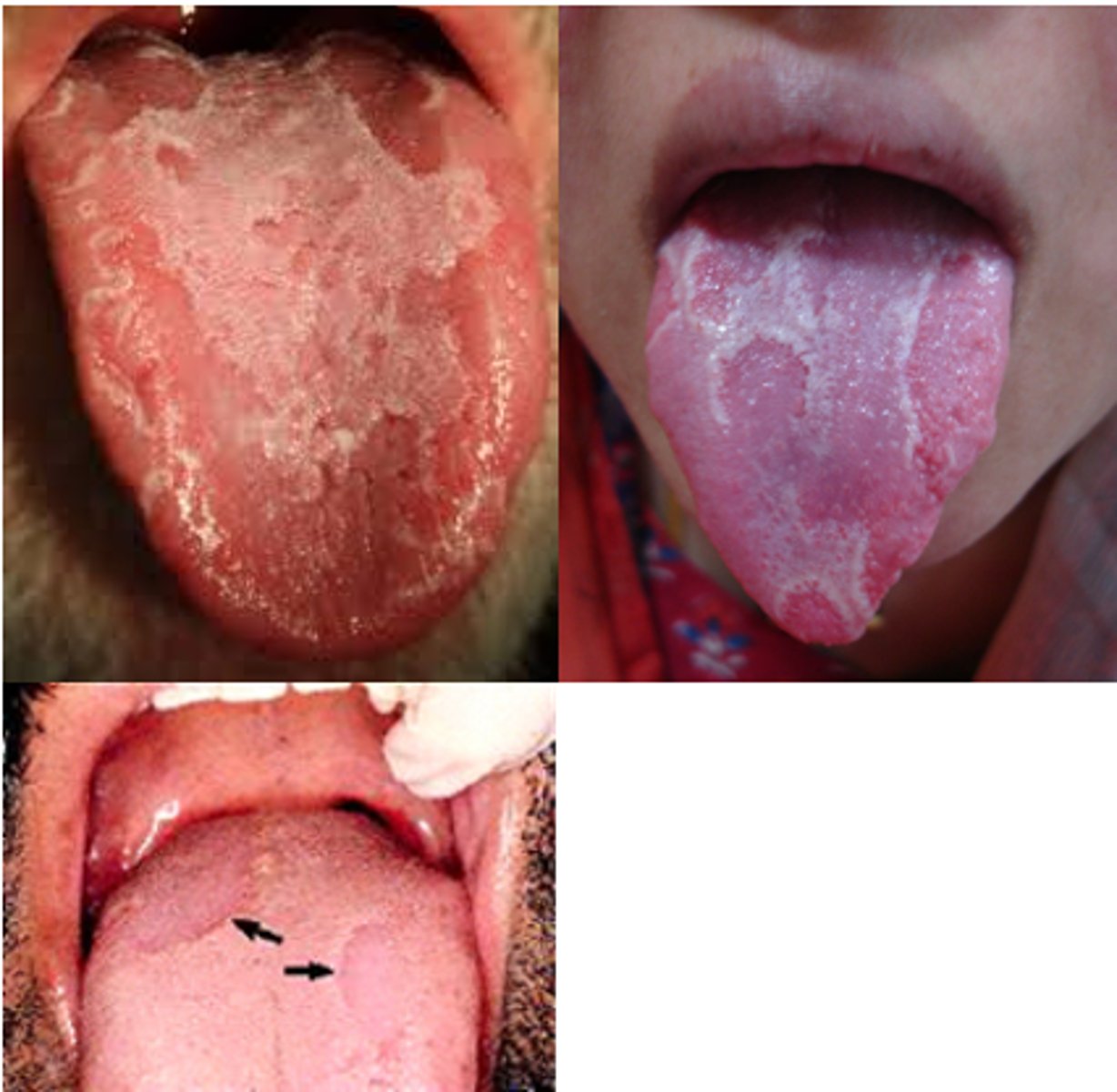 <p>Remission and changes in the surface of the tongue occur.</p><p>Benign migratory glossitis (geographic tongue) is a condition that does not stay the same over time; remission and changes in the surface of the tongue occur. A condition that does not remain static does not refer to treatment protocol. </p><p>Intraoral habits are NOT related to benign migratory glossitis.</p>