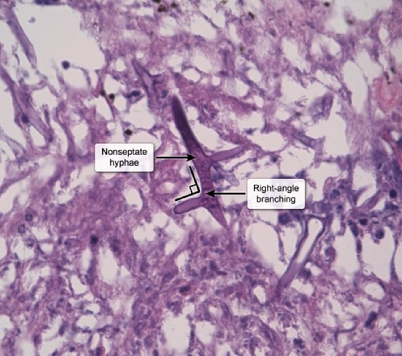 <p>Saprophytic Fungi</p><p>Risk Factors</p><p>-Neutropenic pts</p><p>-Diabetic Ketoacidosis</p><p>Transmission</p><p>-Spore inhalation</p><p>Location</p><p>-Infects Paranasal sinuses</p>