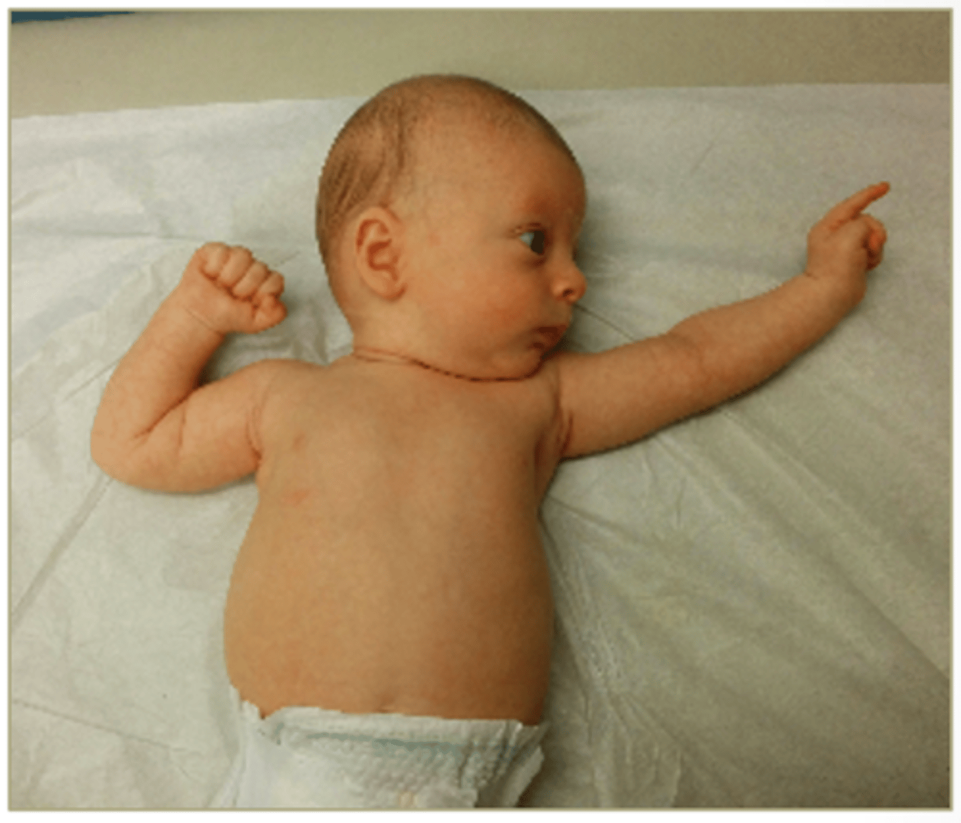 <p>ATNR reflex is commonly seen here</p>