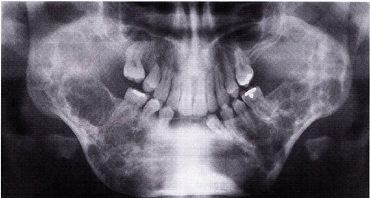 <p>-bilateral facial swelling that appears when the patient is between 1.5 and 4 years of age</p><p>-soap bubble appearance</p>