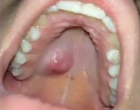 <p>slowly growing lesion, been present for over 10 year, What is the diagnosis?</p>