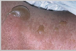 <ul><li><p>Almost Always triggered by <strong>drugs (medication)</strong></p></li><li><p>≥30% body surface is affected</p></li><li><p>Older females</p></li><li><p>Initially on trunk</p></li><li><p>Sever sloughing of skin</p></li></ul><p></p>