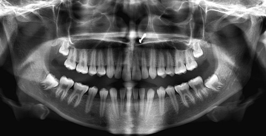 <p><strong>What is this image/procedure called?</strong><br>A. Pinorex<br>B. Dentogram<br>C. Panorex<br>D. Penorex</p>